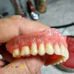 ساخت دندان مصنوعی آلمانی یک روزه