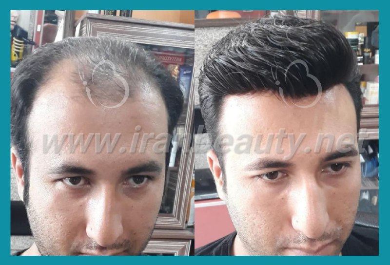 مرکز تخصصی ترمیم مو و زیبایی ایران بیوتی | بهترین کلینیک ترمیم موی سر در تهران | جدیدترین روش های ترمیم مو | ترمیم مو با کلاه گیس با موی طبیعی | ترمیم مو hrt | آدرس ترمیم مو به روش اچ آر تی ترمیم مو  | ترمیم مو فیکس آلمان | پروتز مو